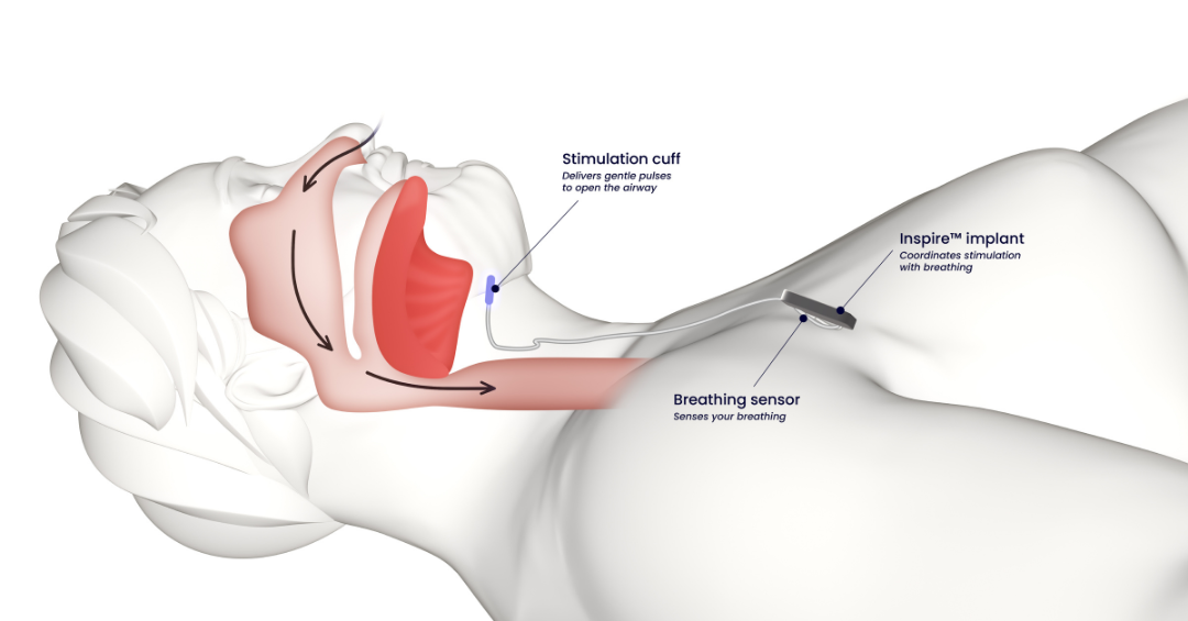 Visual diagram of Inspire Therapy technology.