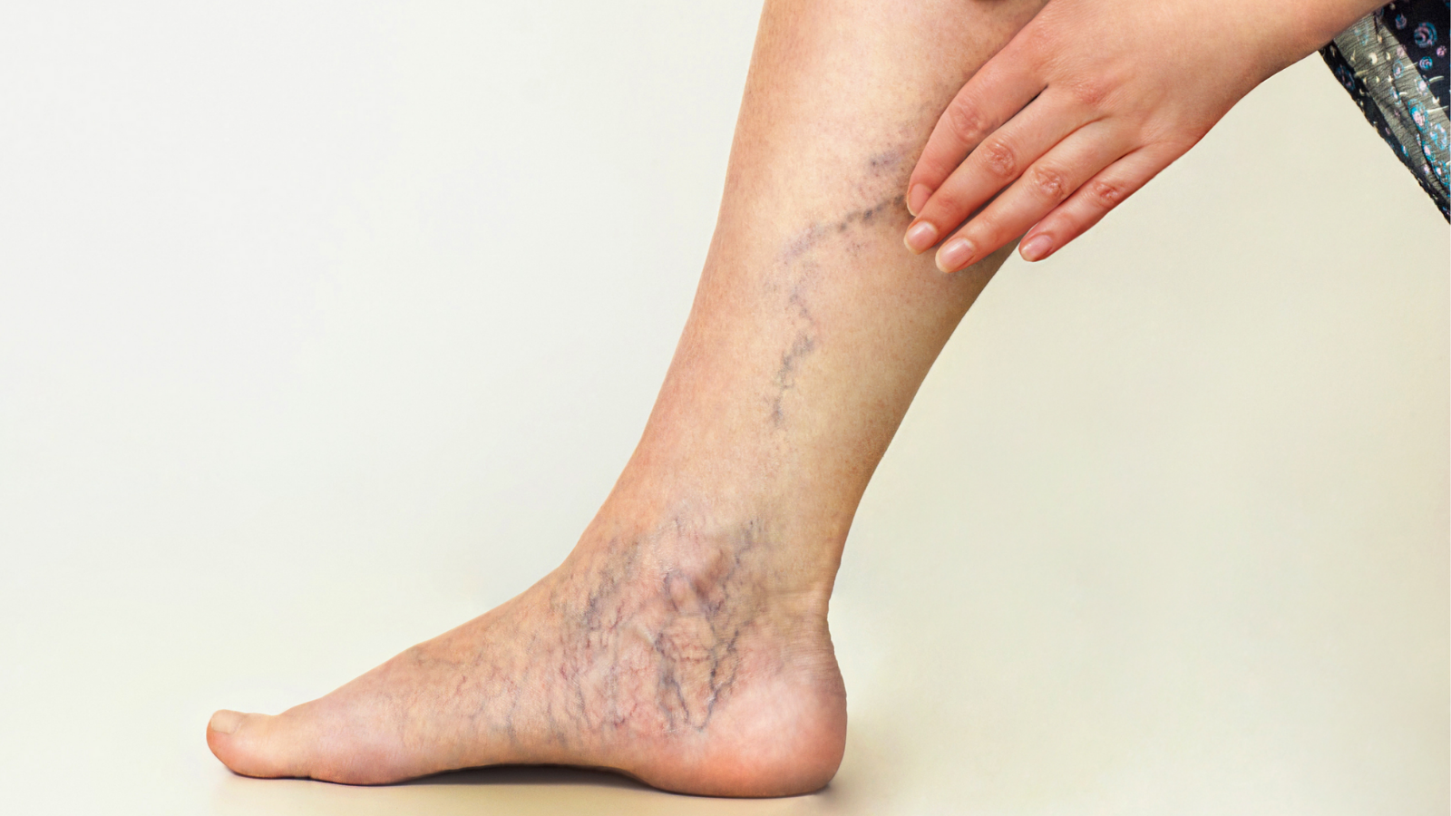 Varicose Veins or Venous Insufficiency Treatment  Vein Clinic of Northeast  Nebraska - Norfolk, NE