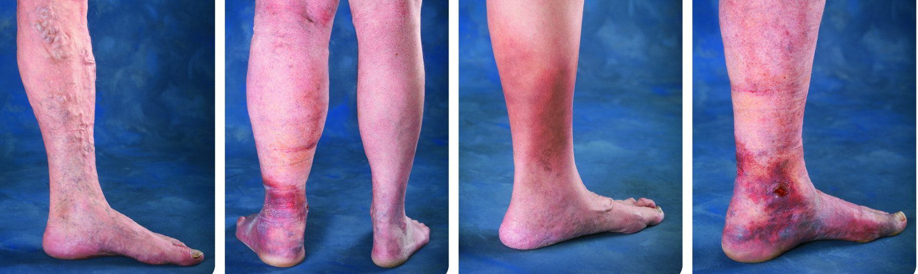 Venous Disease Progression