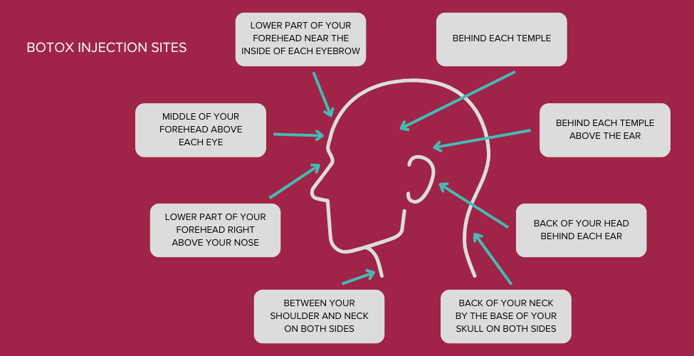 Botox injection sites