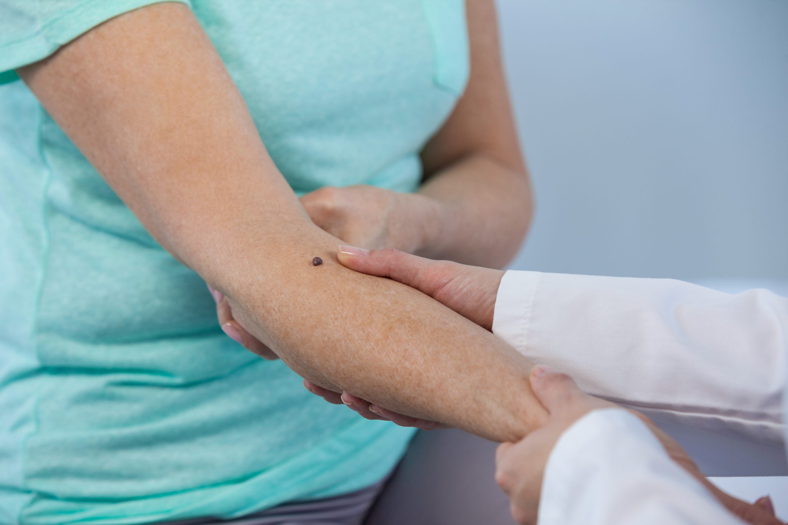 Doctor examines mole on patient